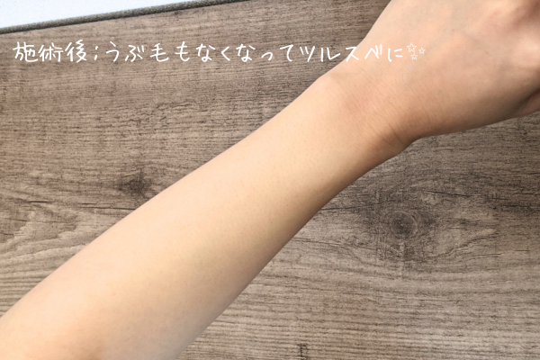 脱毛後の腕