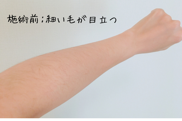 通う前の腕