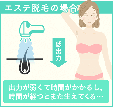 エステ脱毛