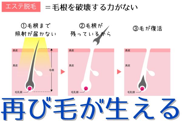 エステ脱毛