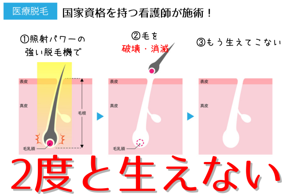 医療脱毛原理