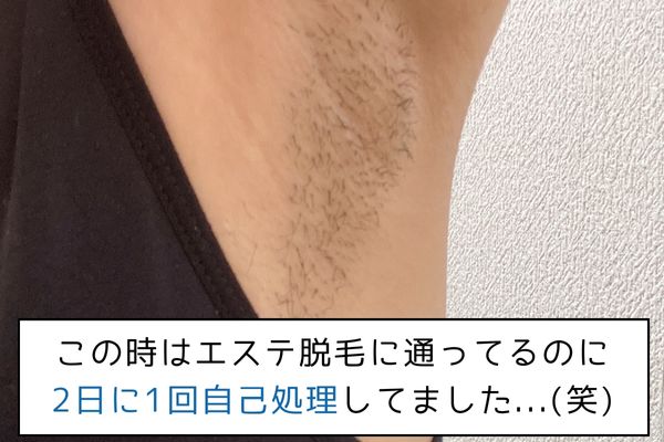 エステ毛が復活