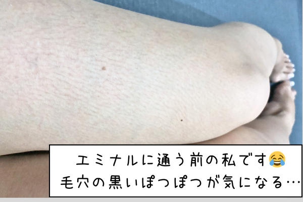 ビフォー