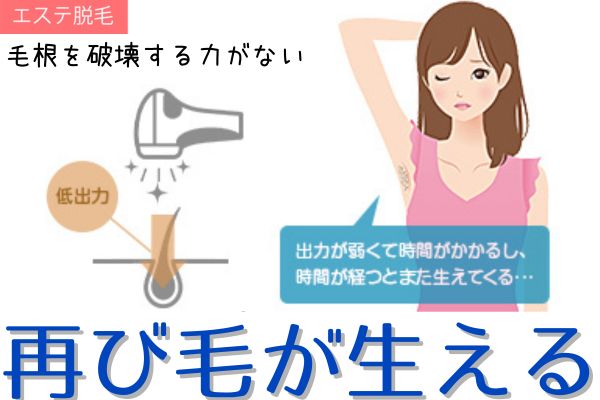 エステ脱毛