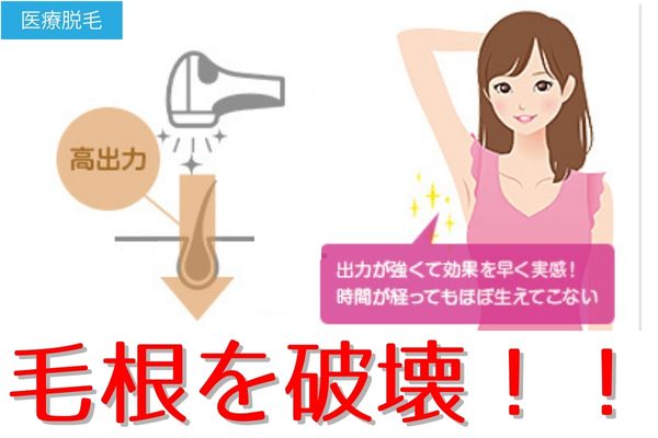 医療脱毛原理