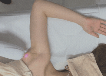 脇施術