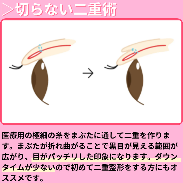 切らない二重